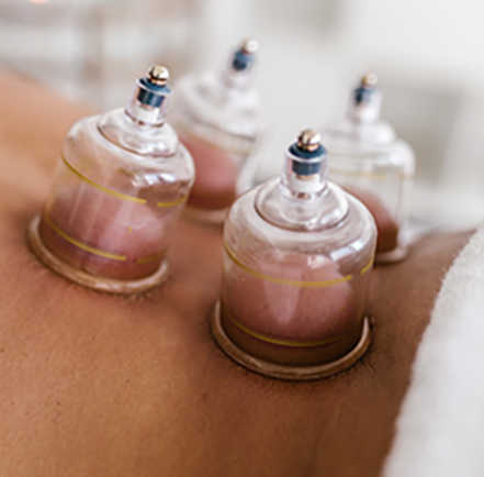 Cupping behandeling met 4 cups bij een klant 