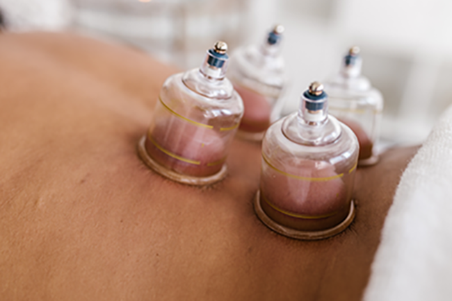 Cupping bij een klant met 4 cups<br />
